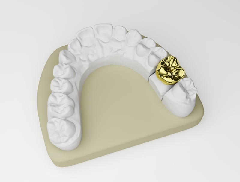 Gold tooth crown