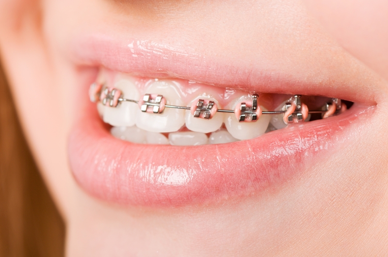 Person wearing braces.