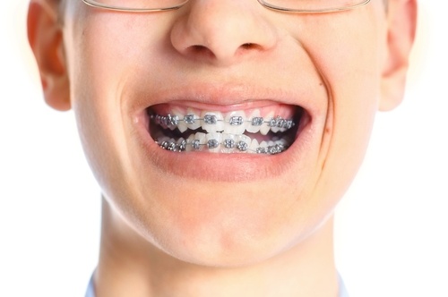 Learn-how-you-can-cope-with-braces.jpg