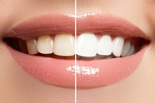 Should-you-whiten-your-teeth.jpg