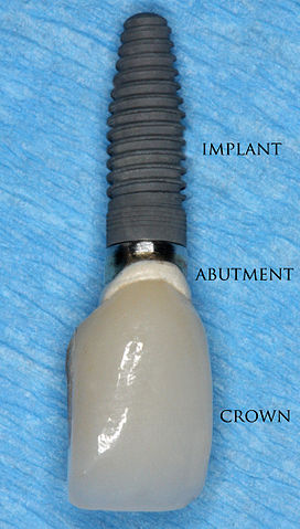 Dental implants