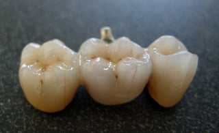 porcelain dental bridge